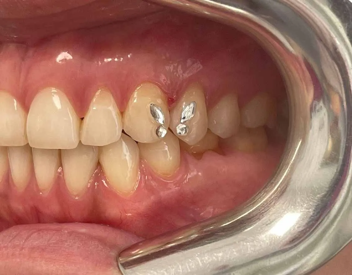 joyas dentales asesor de imagen
